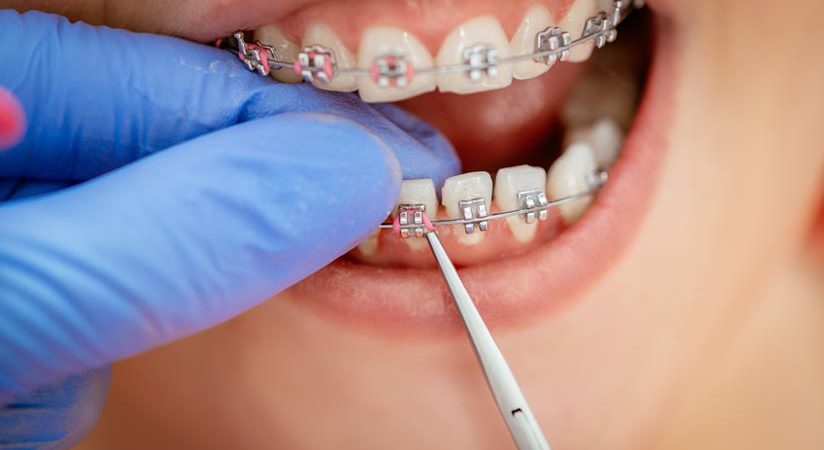 Dentist checking bracket at the braces on the female patient. Close-up. Real People.